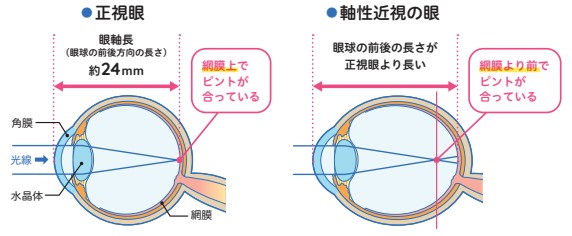 正視眼と軸性近視の眼の比較図