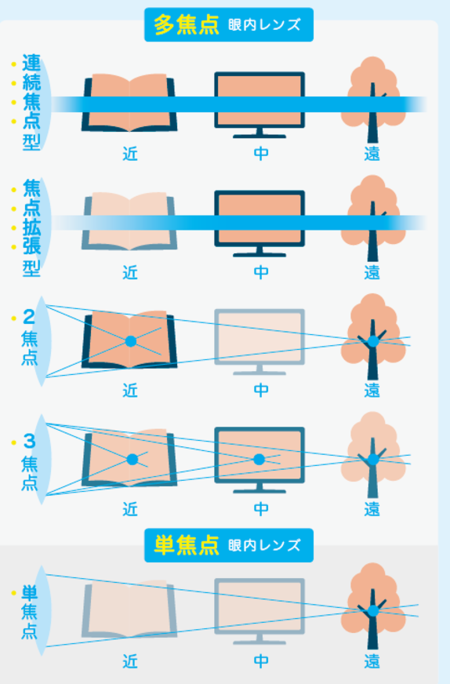 多焦点と単焦点眼内レンズ