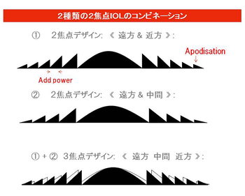 2種類の2焦点IOLのコンビネーション
