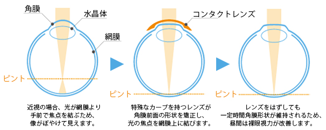 就寝時に特殊なハードコンタクトレンズを装用する治療の図