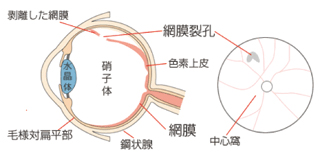 網膜円孔・網膜裂孔の図