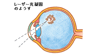 レーザー光凝固の図