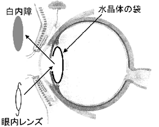 水晶体嚢の図