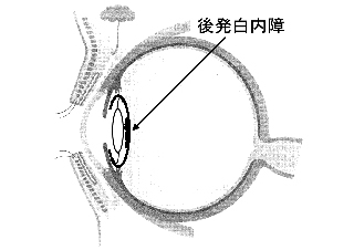 後発白内障の図